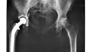 ‘Alotta Lip About my Hip’ and Other Hip Replacement Poetry by Jeff Kemper