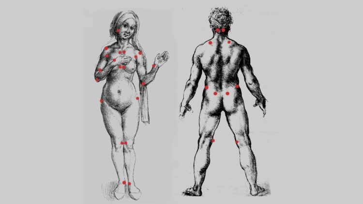 Fibromyalgie Tender Points outlined on a Da Vinci drawing (Richard Huber)